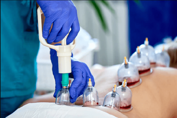 how hijama works