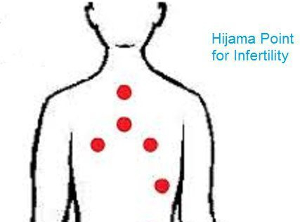 Hijama points for infertility