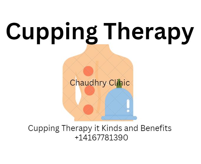 cupping therapy
